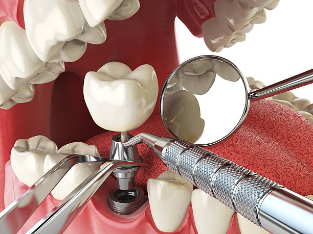 Best Emergency Treatment for Dental Infections or Abscesses in Greenwood, DE
